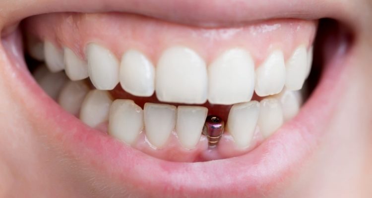 Quand l&rsquo;implant dentaire est salutaire